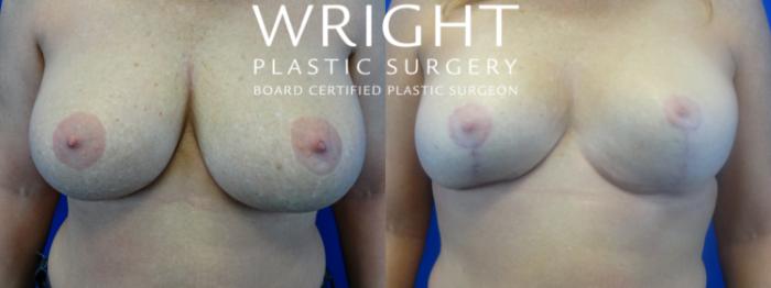 Before & After Breast Reduction Case 21 Front View in Little Rock, Arkansas