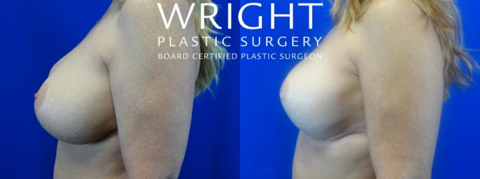 Before & After Breast Reduction Case 21 Left Side View in Little Rock, Arkansas