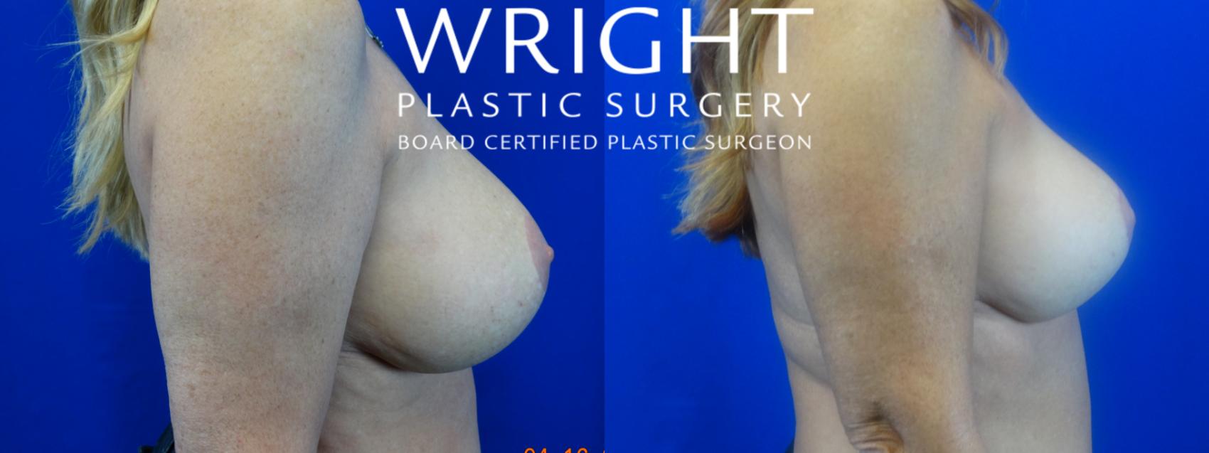Before & After Breast Reduction Case 21 Right Side View in Little Rock, Arkansas