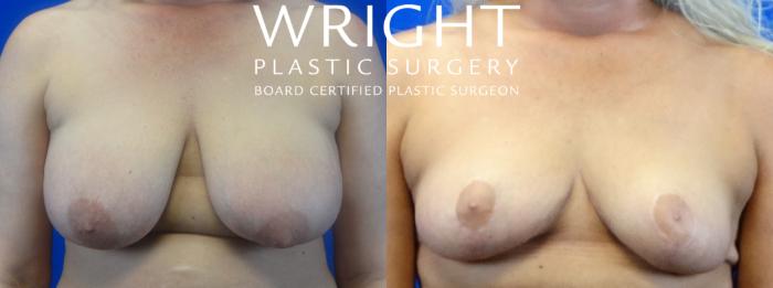 Before & After Breast Reduction Case 22 Front View in Little Rock, Arkansas