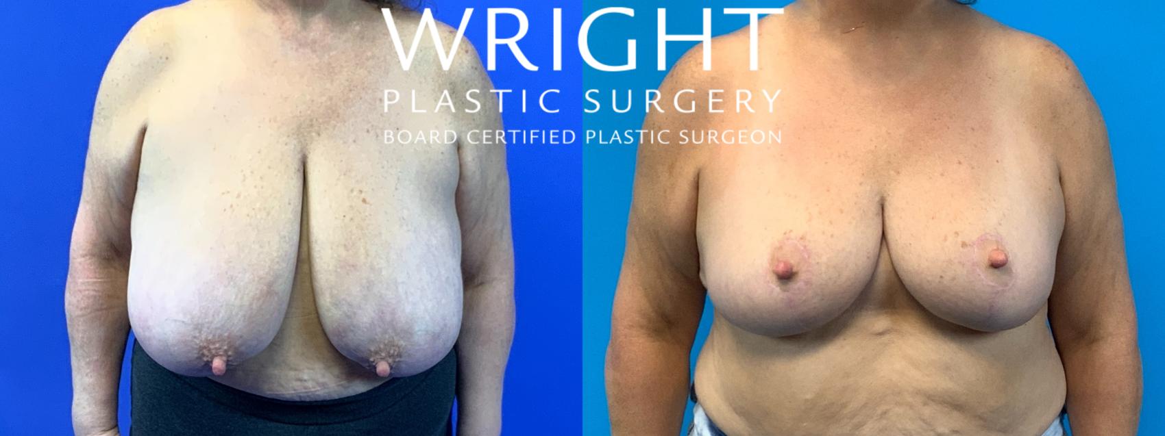 Before & After Breast Reduction Case 232 Front View in Little Rock, Arkansas