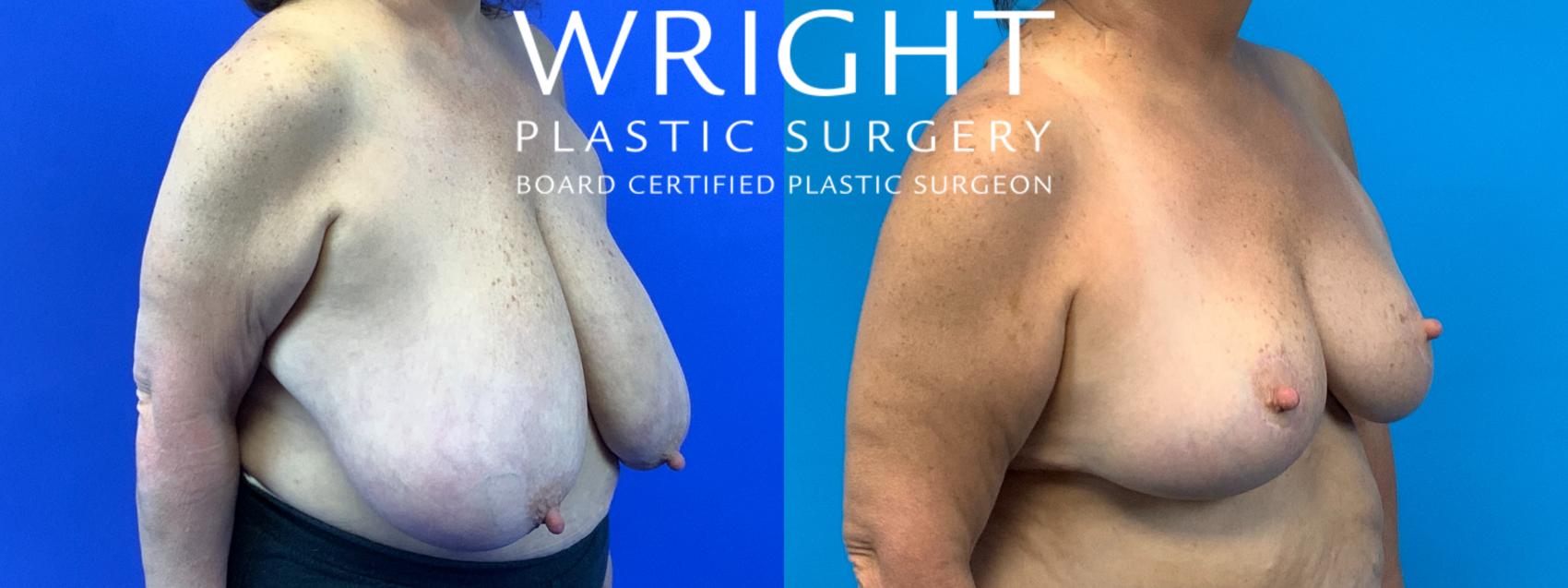 Before & After Breast Reduction Case 232 Right Oblique View in Little Rock, Arkansas