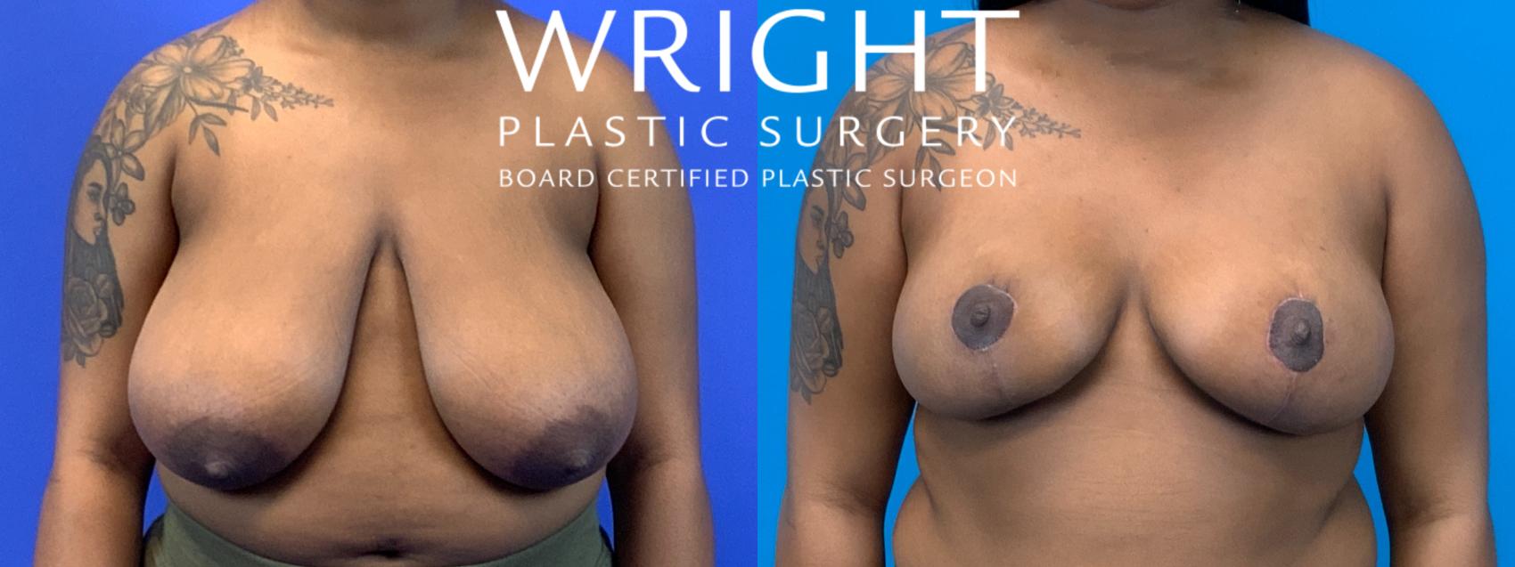 Before & After Breast Reduction Case 249 Front View in Little Rock, Arkansas