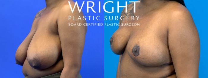 Before & After Breast Reduction Case 249 Left Oblique View in Little Rock, Arkansas