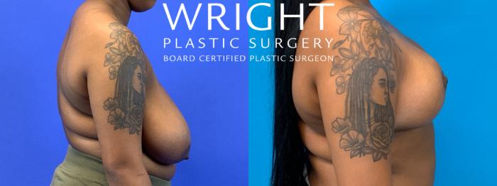 Before & After Breast Reduction Case 249 Right Side View in Little Rock, Arkansas