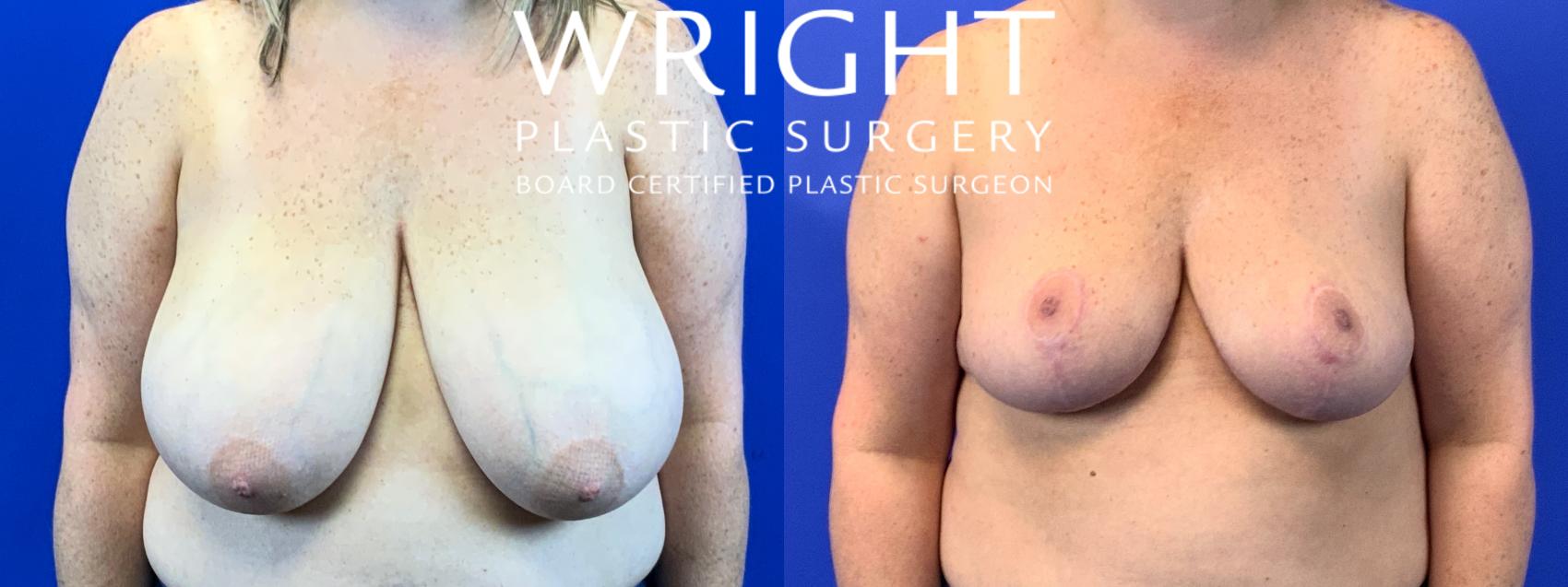 Before & After Breast Reduction Case 276 Front View in Little Rock, Arkansas