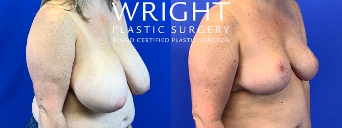 Before & After Breast Reduction Case 276 Right Oblique View in Little Rock, Arkansas