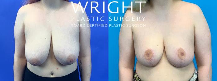 Before & After Breast Reduction Case 280 Front View in Little Rock, Arkansas