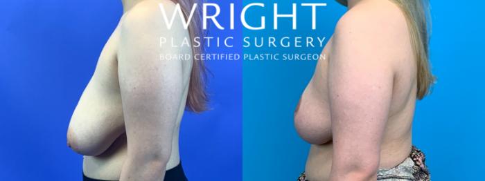 Before & After Breast Reduction Case 280 Left Side View in Little Rock, Arkansas