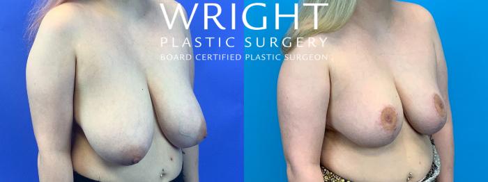 Before & After Breast Reduction Case 280 Right Oblique View in Little Rock, Arkansas