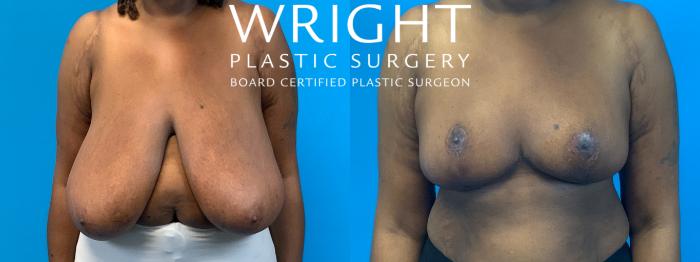 Before & After Breast Reduction Case 290 Front View in Little Rock, Arkansas