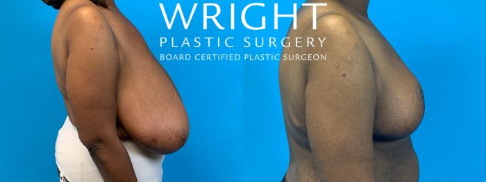 Before & After Breast Reduction Case 290 Right Side View in Little Rock, Arkansas