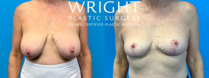 Before & After Breast Reduction Case 298 Front View in Little Rock, Arkansas