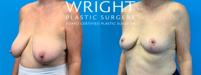 Before & After Breast Reduction Case 298 Left Oblique View in Little Rock, Arkansas