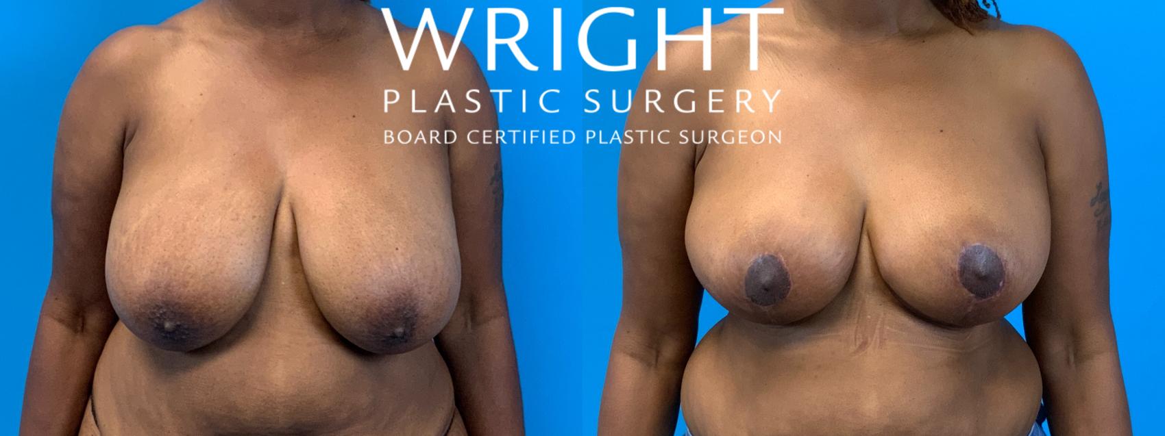 Before & After Breast Reduction Case 329 Front View in Little Rock, Arkansas