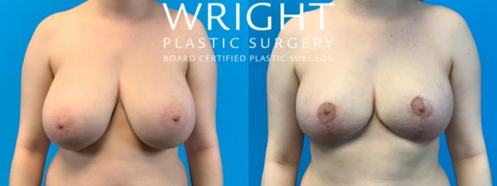 Before & After Breast Reduction Case 356 Front View in Little Rock, Arkansas