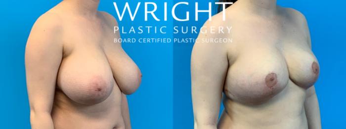 Before & After Breast Reduction Case 356 Left Oblique View in Little Rock, Arkansas