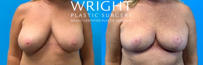 Before & After Breast Reduction Case 366 Front View in Little Rock, Arkansas