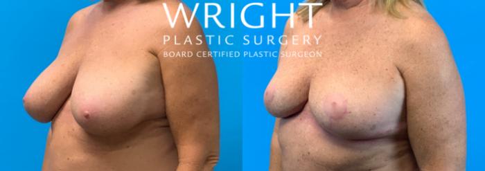 Before & After Breast Reduction Case 366 Left Oblique View in Little Rock, Arkansas