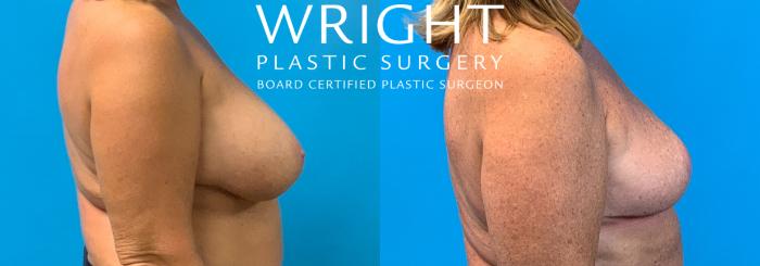 Before & After Breast Reduction Case 366 Right Side View in Little Rock, Arkansas
