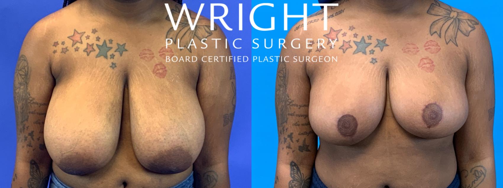 Before & After Breast Reduction Case 372 Front View in Little Rock, Arkansas