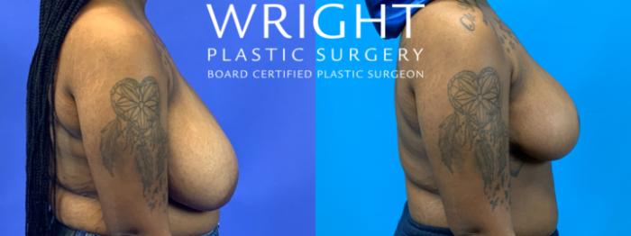 Before & After Breast Reduction Case 372 Right Side View in Little Rock, Arkansas