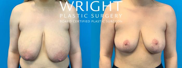 Before & After Breast Reduction Case 398 Front View in Little Rock, Arkansas