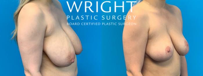Before & After Breast Reduction Case 398 Right Oblique View in Little Rock, Arkansas