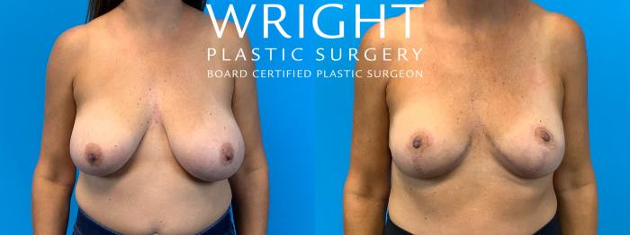 Before & After Breast Reduction Case 401 Front View in Little Rock, Arkansas