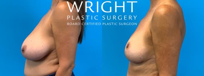 Before & After Breast Reduction Case 401 Left Side View in Little Rock, Arkansas