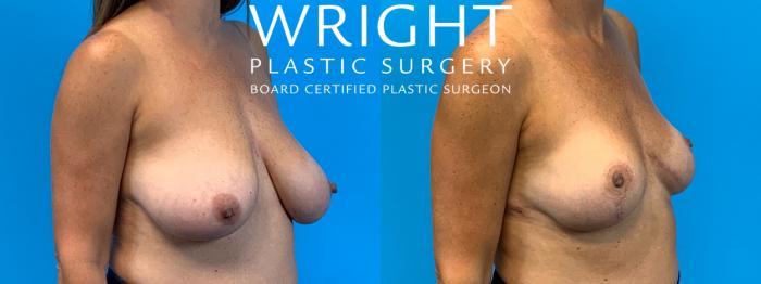 Before & After Breast Reduction Case 401 Right Oblique View in Little Rock, Arkansas