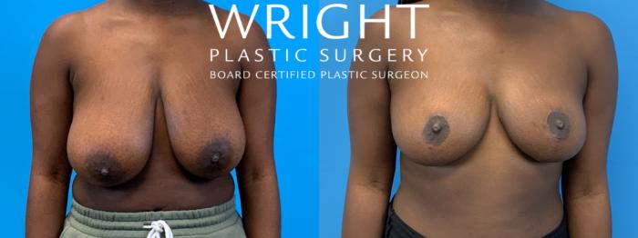 Before & After Breast Reduction Case 406 Front View in Little Rock, Arkansas