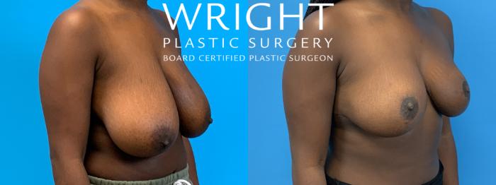 Before & After Breast Reduction Case 406 Right Oblique View in Little Rock, Arkansas