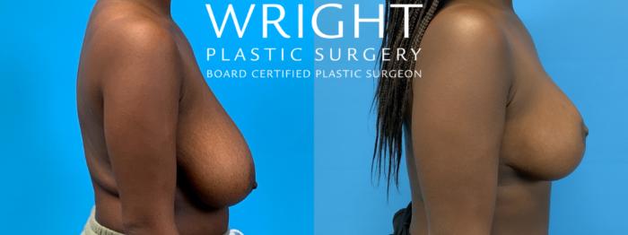 Before & After Breast Reduction Case 406 Right Side View in Little Rock, Arkansas