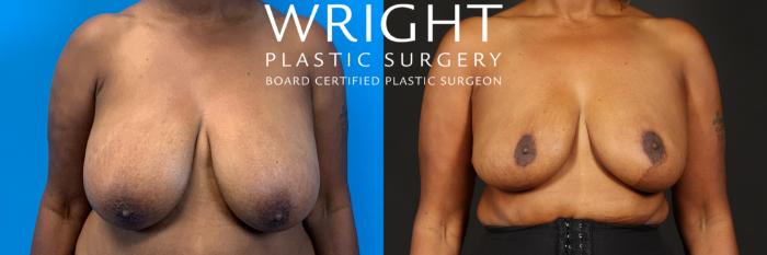 Before & After Breast Reduction Case 438 Front View in Little Rock, Arkansas