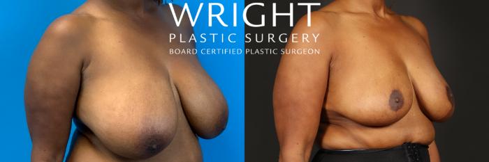 Before & After Breast Reduction Case 438 Right Oblique View in Little Rock, Arkansas