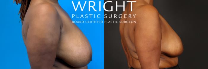 Before & After Breast Reduction Case 438 Right Side View in Little Rock, Arkansas