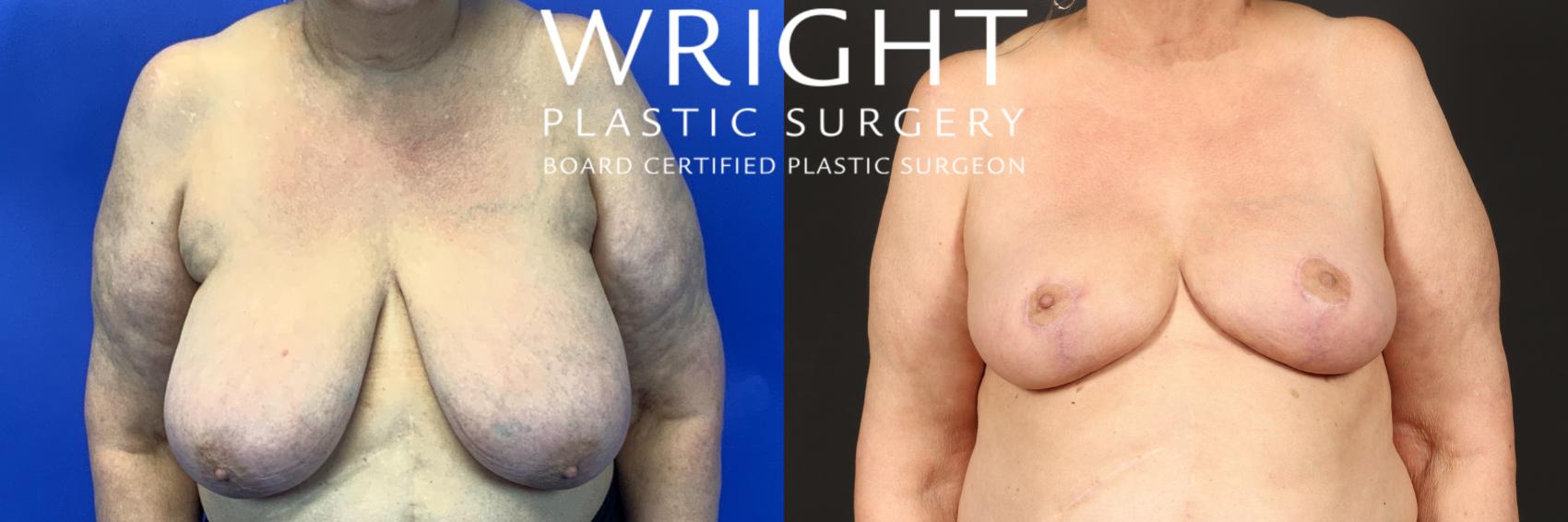 Before & After Breast Reduction Case 448 Front View in Little Rock, Arkansas