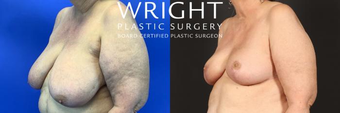 Before & After Breast Reduction Case 448 Left Oblique View in Little Rock, Arkansas