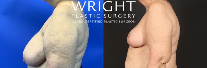 Before & After Breast Reduction Case 448 Left Side View in Little Rock, Arkansas