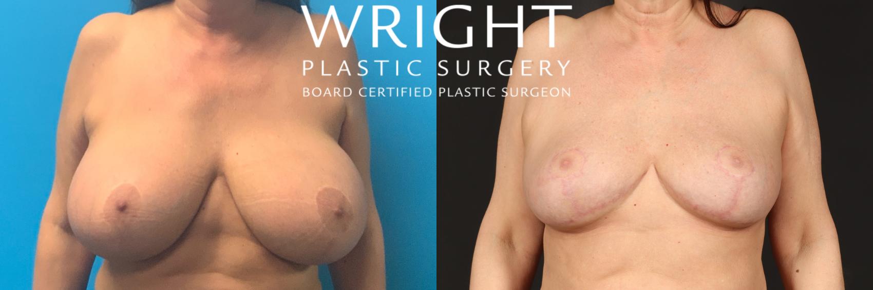 Before & After Breast Reduction Case 466 Front View in Little Rock, Arkansas