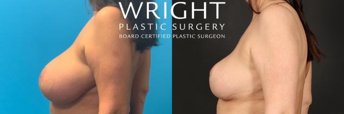 Before & After Breast Reduction Case 466 Left Side View in Little Rock, Arkansas