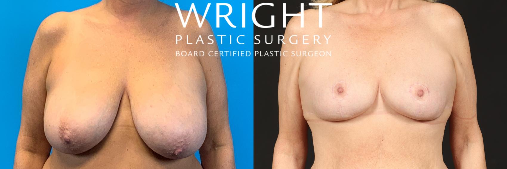 Before & After Breast Reduction Case 480 Front View in Little Rock, Arkansas