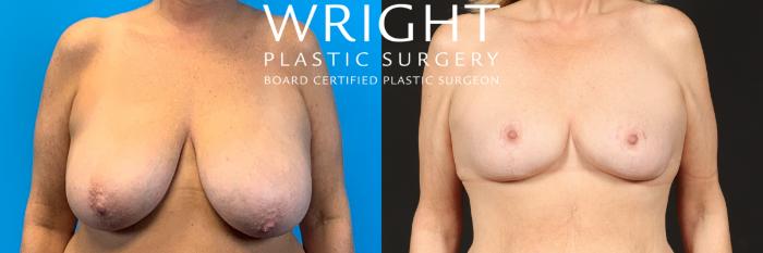 Before & After Breast Reduction Case 480 Front View in Little Rock, Arkansas