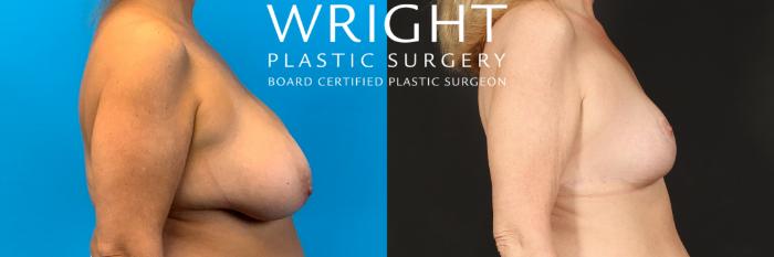 Before & After Breast Reduction Case 480 Right Side View in Little Rock, Arkansas