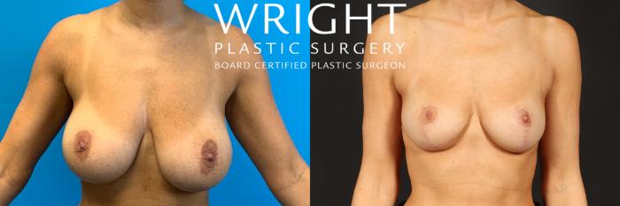 Before & After Breast Reduction Case 484 Front View in Little Rock, Arkansas