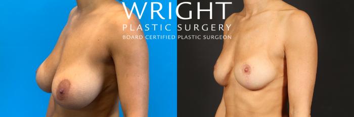 Before & After Breast Reduction Case 484 Left Oblique View in Little Rock, Arkansas