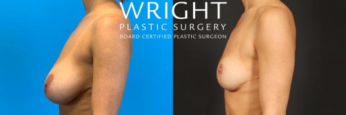 Before & After Breast Reduction Case 484 Left Side View in Little Rock, Arkansas