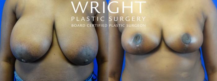 Before & After Breast Reduction Case 5 View 1 View in Little Rock, Arkansas
