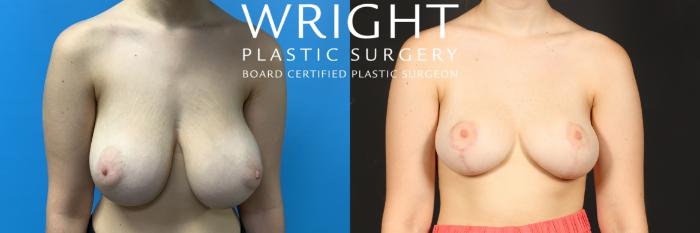 Before & After Breast Reduction Case 502 Front View in Little Rock, Arkansas